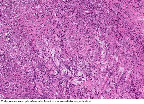 Nodular fasciitis pathology